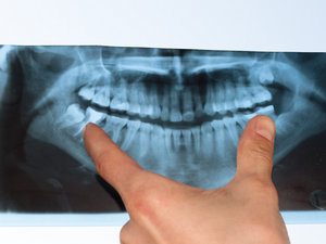 Wisdom teeth should be removed as soon as possible.