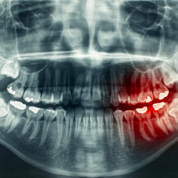 X-ray of wisdom teeth coming in.