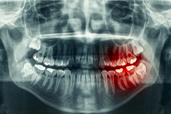 X-ray of wisdom teeth coming in.
